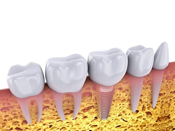 Dental Implants Procedure in Preston