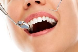 Tooth Coloured Fillings | Dentist Preston