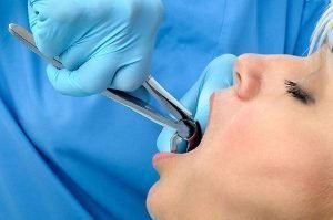 Tooth Extraction | Dentist Preston